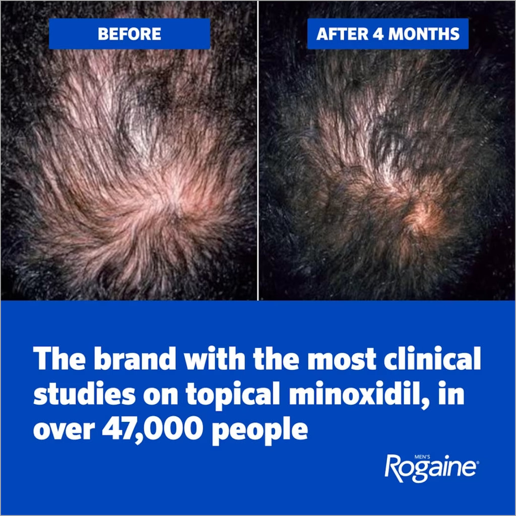 Men's Rogaine 5% Minoxidil Foam for hair loss and hair regrowth in Pakistan